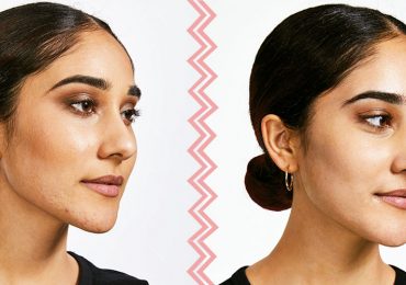 Acne Archivos Revista Cosmopolitan