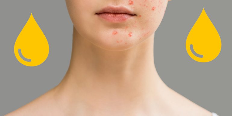 la-orina-puede-curar-el-acne