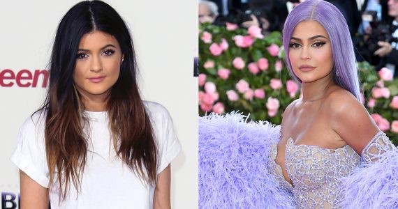 kylie-jenner-cirugías
