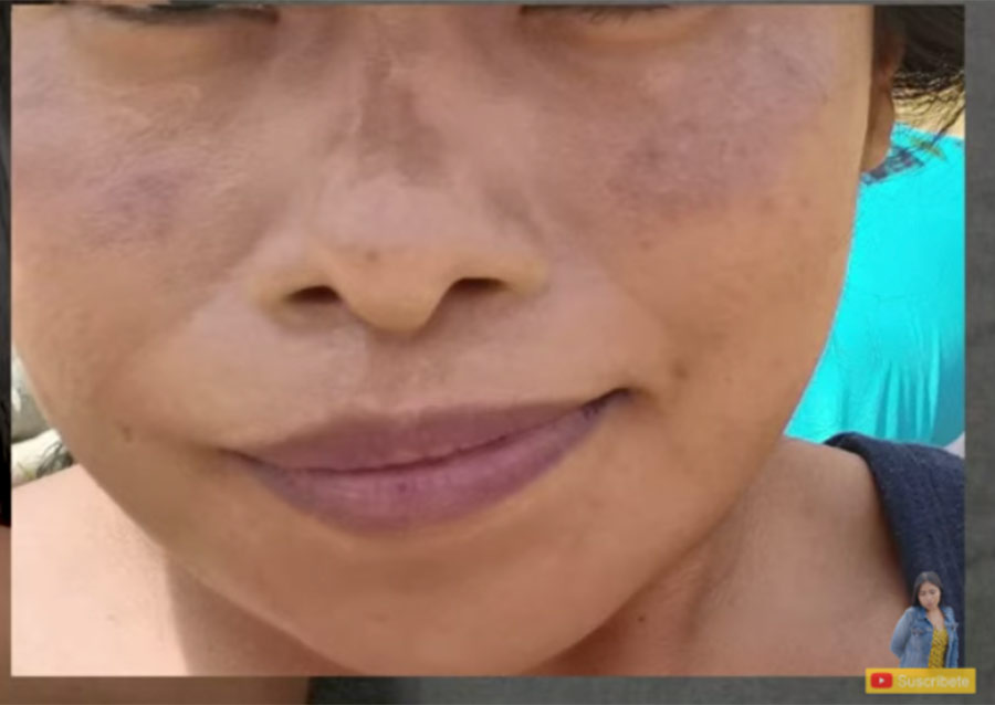 Yalitza Aparicio revela que tiene una enfermedad en la piel que ha cambiado su aspecto